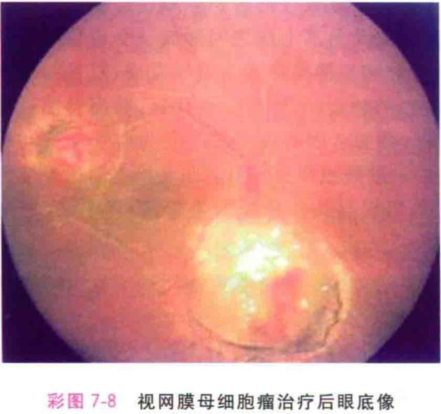 视网膜母细胞瘤的转移及其影响