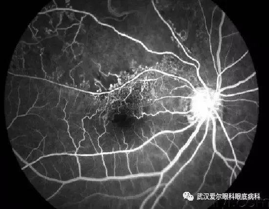 眼底巨细胞，深入了解与探索