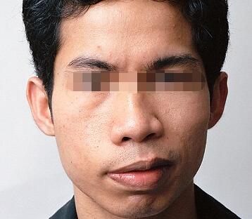 面瘫怎样治疗效果好，全面解析面瘫治疗策略