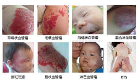 血管瘤治疗效果及其影响因素分析