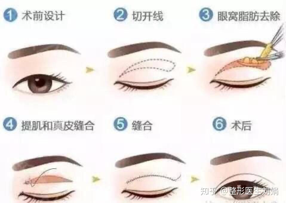 做近视手术后需要带眼罩吗？全面解析近视手术后的眼部护理