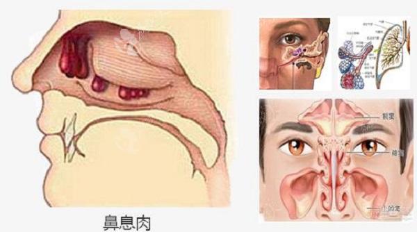 鼻子里长息肉图片，了解鼻息肉及其相关影像