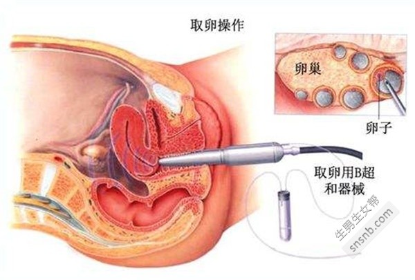 试管婴儿技术中的女性取卵过程详解