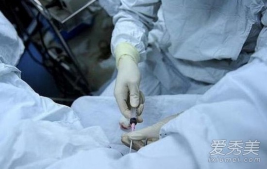 试管婴儿技术中女性取卵过程详解